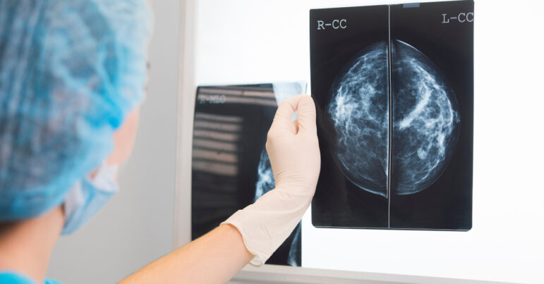 A doctor holds up a mammogram in front of an X-Ray illuminator