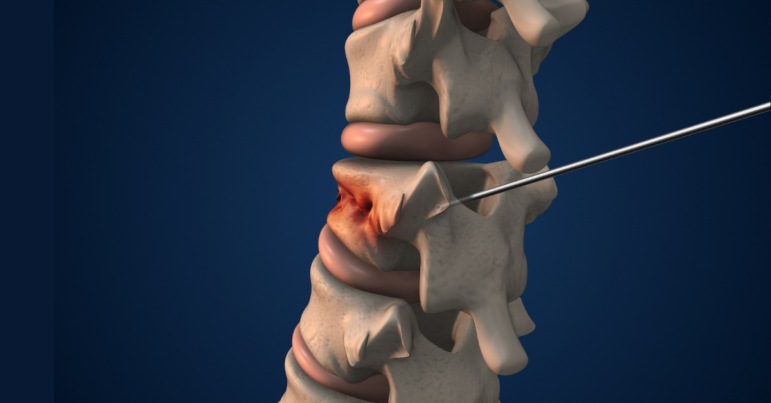 Vertebroplasty: The Myth of the Most Effective Medical Intervention
